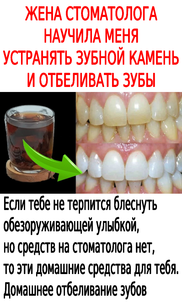 ЖЕНА СТОМАТОЛОГА НАУЧИЛА МЕНЯ УСТРАНЯТЬ ЗУБНОЙ КАМЕНЬ И ОТБЕЛИВАТЬ ЗУБЫ ЗА 4 МИНУТЫ