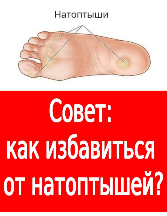 Совет: как избавиться от натоптышей?